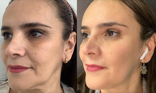 non invasive facelift results before after